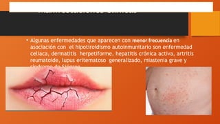 Manifestaciones clínicas
• Algunas enfermedades que aparecen con menor frecuencia en
asociación con el hipotiroidismo autoinmunitario son enfermedad
celiaca, dermatitis herpetiforme, hepatitis crónica activa, artritis
reumatoide, lupus eritematoso generalizado, miastenia grave y
síndrome de Sjögren.
 