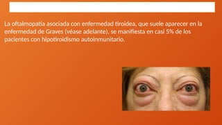 La oftalmopatía asociada con enfermedad tiroidea, que suele aparecer en la
enfermedad de Graves (véase adelante), se manifiesta en casi 5% de los
pacientes con hipotiroidismo autoinmunitario.
Manifestaciones clínicas
 