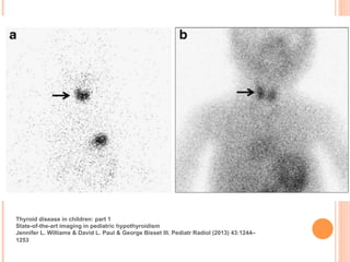 Thyroid disease in children: part 1
State-of-the-art imaging in pediatric hypothyroidism
Jennifer L. Williams & David L. Paul & George Bisset III. Pediatr Radiol (2013) 43:1244–
1253!
 