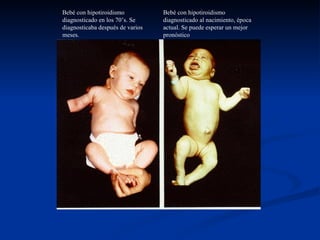 Bebé con hipotiroidismo diagnosticado en los 70’s. Se diagnosticaba después de varios meses. Bebé con hipotiroidismo diagnosticado al nacimiento, época actual. Se puede esperar un mejor pronóstico 
