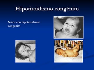Hipotiroidismo congénito Niños con hipotiroidismo congénito 