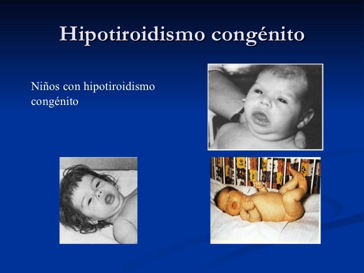 Hipotiroidismo congenito