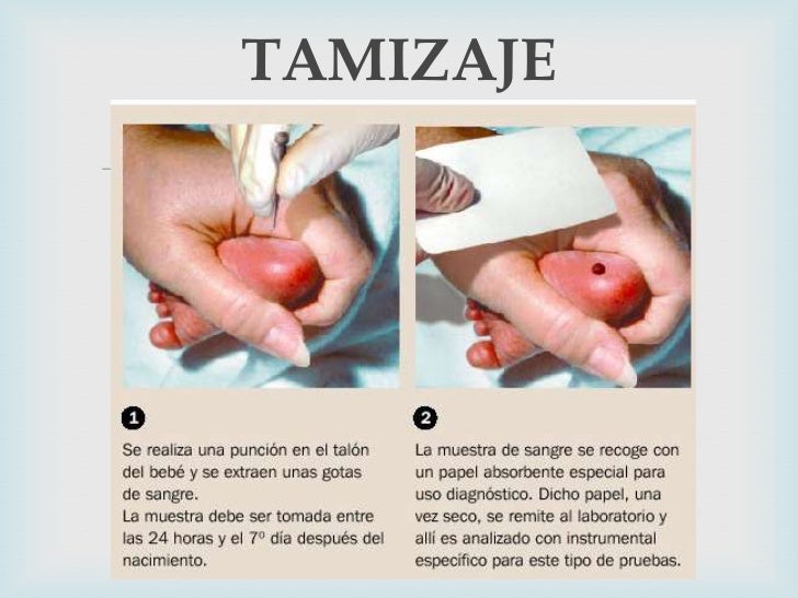 HIPOTIROIDISMO CONGENITO PDF