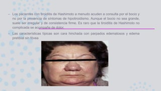 – Los pacientes con tiroiditis de Hashimoto a menudo acuden a consulta por el bocio y
no por la presencia de síntomas de hipotiroidismo. Aunque el bocio no sea grande,
suele ser irregular y de consistencia firme, Es raro que la tiroiditis de Hashimoto no
complicada se acompañe de dolor.
– Las características típicas son cara hinchada con parpados edematosos y edema
pretibial sin fóvea
 
