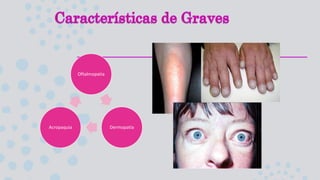 Oftalmopatia
Dermopatía
Acropaquia
 