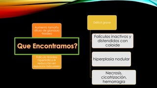 Aumento tamaño
difuso de glandula
tiroidea
Folículo tiroideo
hipertrófico
reducción en
espacios foliculares
Déficit grave
Folículos inactivos y
distendidos con
coloide
hiperplasia nodular
Necrosis,
cicatrización,
hemorragia
 