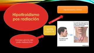 Consecuencia del
yodo radioactivo
50-70%
>10mCi
Hipotiroidismo clinico
 