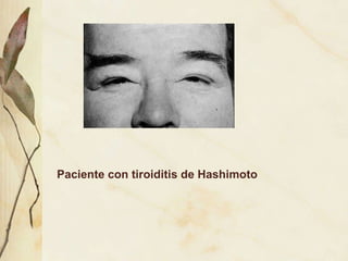 Paciente con tiroiditis de Hashimoto 
