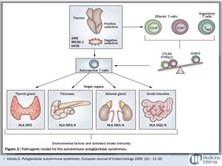 HIPOTIROIDISMO PRIMARIO
- Kahaly G. Polyglandular autoimmune syndromes. European Journal of Endocrinology 2009; 161 : 11–20.
Incidencia
Mujeres 3.5 casos X 1000 personas por año
Hombres 0.8 casos X 1000 personas por año
 4ta y 6ta décadas de la vida.
 Alteración en la síntesis de hormonas por destrucción de células
tiroideas por un trastorno autoinmune.
 