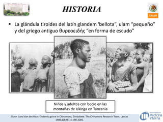  La glándula tiroides del latín glandem 'bellota”, ulam “pequeño”
y del griego antiguo θυρεοειδής “en forma de escudo”
Niños y adultos con bocio en las
montañas de Ukinga en Tanzania
HISTORIA
Dunn J and Van des Haar. Endemic goitre in Chinamora, Zimbabwe. The Chinamora Research Team. Lancet
1986;1(8491):1198-2005.
 