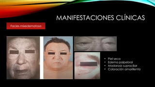 MANIFESTACIONES CLÍNICAS
• Piel seca
• Edema palpebral
• Madarosis supraciliar
• Coloración amarillenta
Facies mixedematosa
 