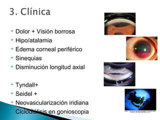 Hipotonía ocular | PPT