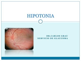 Dr.carlosgrau Servicio de glaucoma HIPOTONIA 