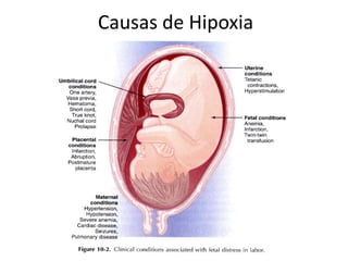 Hipoxia Fetal Y RCIU PPTX hipoxia-fetal-y-rciu-pptx