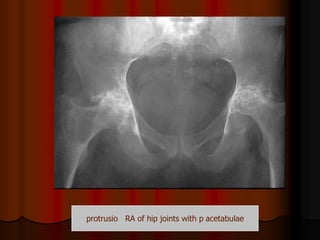 acetabulaeprotrusio RA of hip joints with p
 