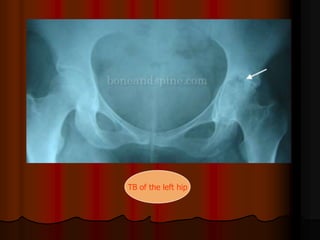 TB of the left hip
 