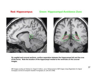 HIPPOCAMPUS TARGET DELINEATION | PPT