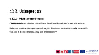 5.2.3.1.What is osteoporosis
Osteoporosis is a disease in which the density and quality of bones are reduced.
As bones become more porous and fragile, the risk of fracture is greatly increased.
The loss of bone occurs silently and progressively.
 