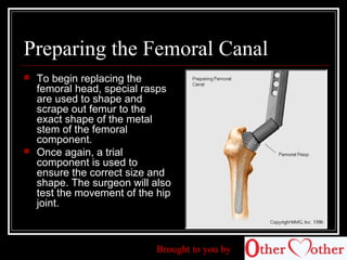 hipreplacement-140718021057-phpapp01.pdf