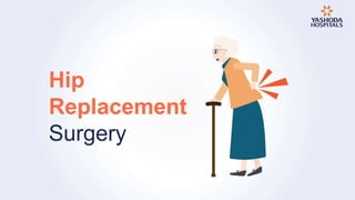 Hip
Replacement
Surgery
 