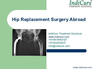 Hip Replacement Surgery Abroad

              IndiCure Treatment Solutions
              www.indicure.com
              +919818462127
              +91932003677
              info@indicure.com




                                  www.indicure.com
 