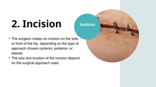 Hip Replacement Surgery Procedure-Dr Abhinav Kesarkar (1).pptx