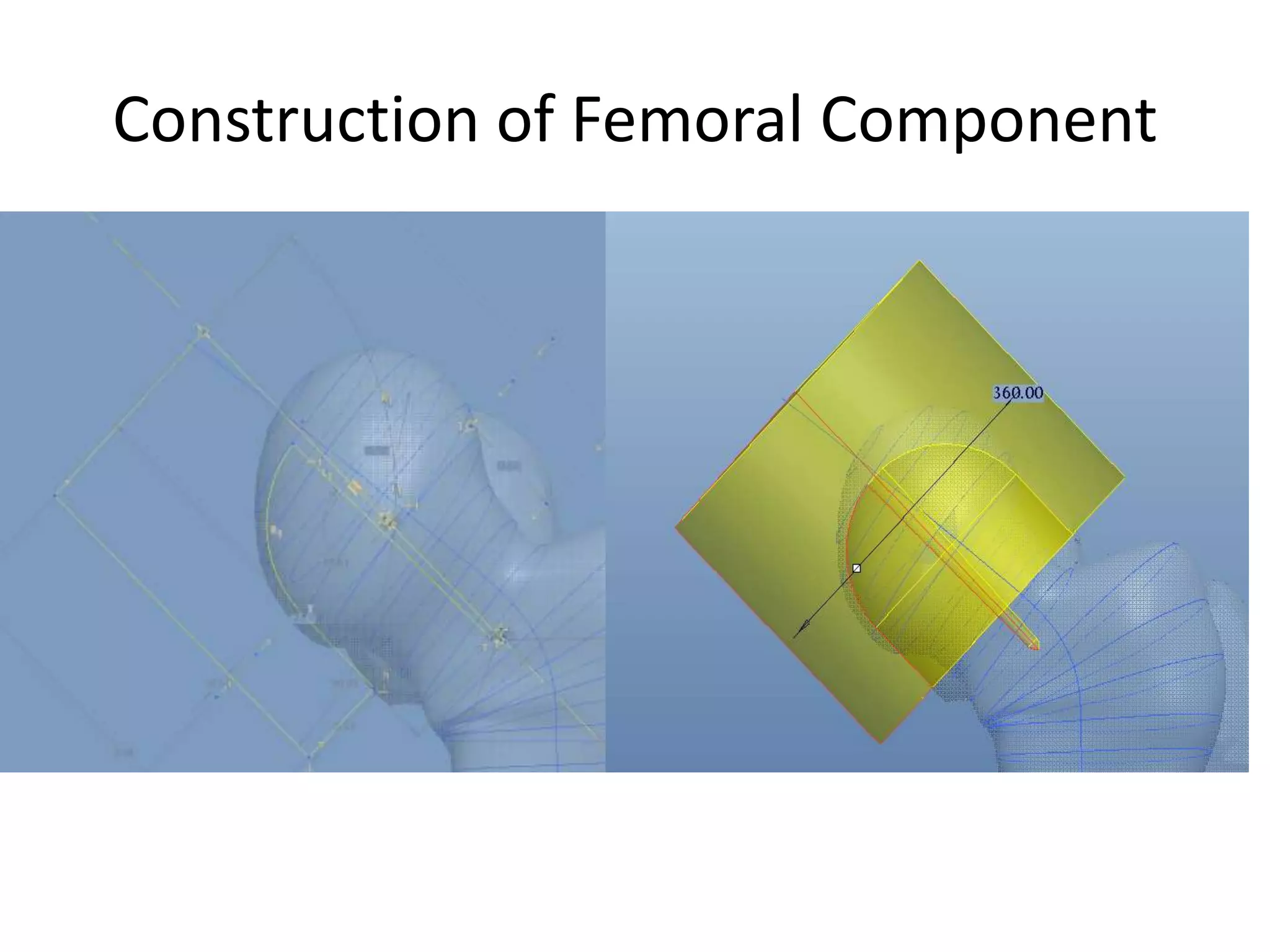 Construction of Femoral Component