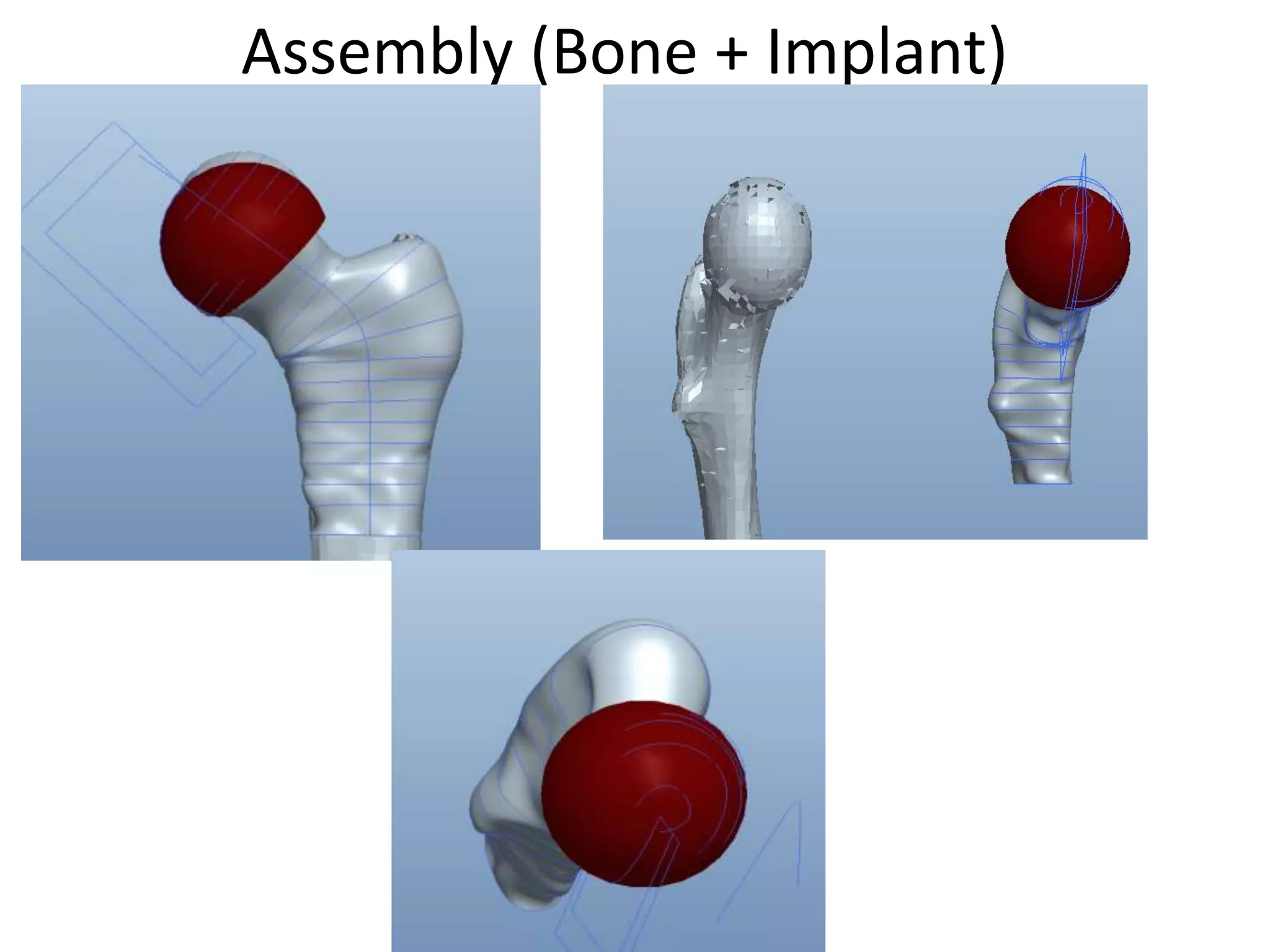 Assembly (Bone + Implant)