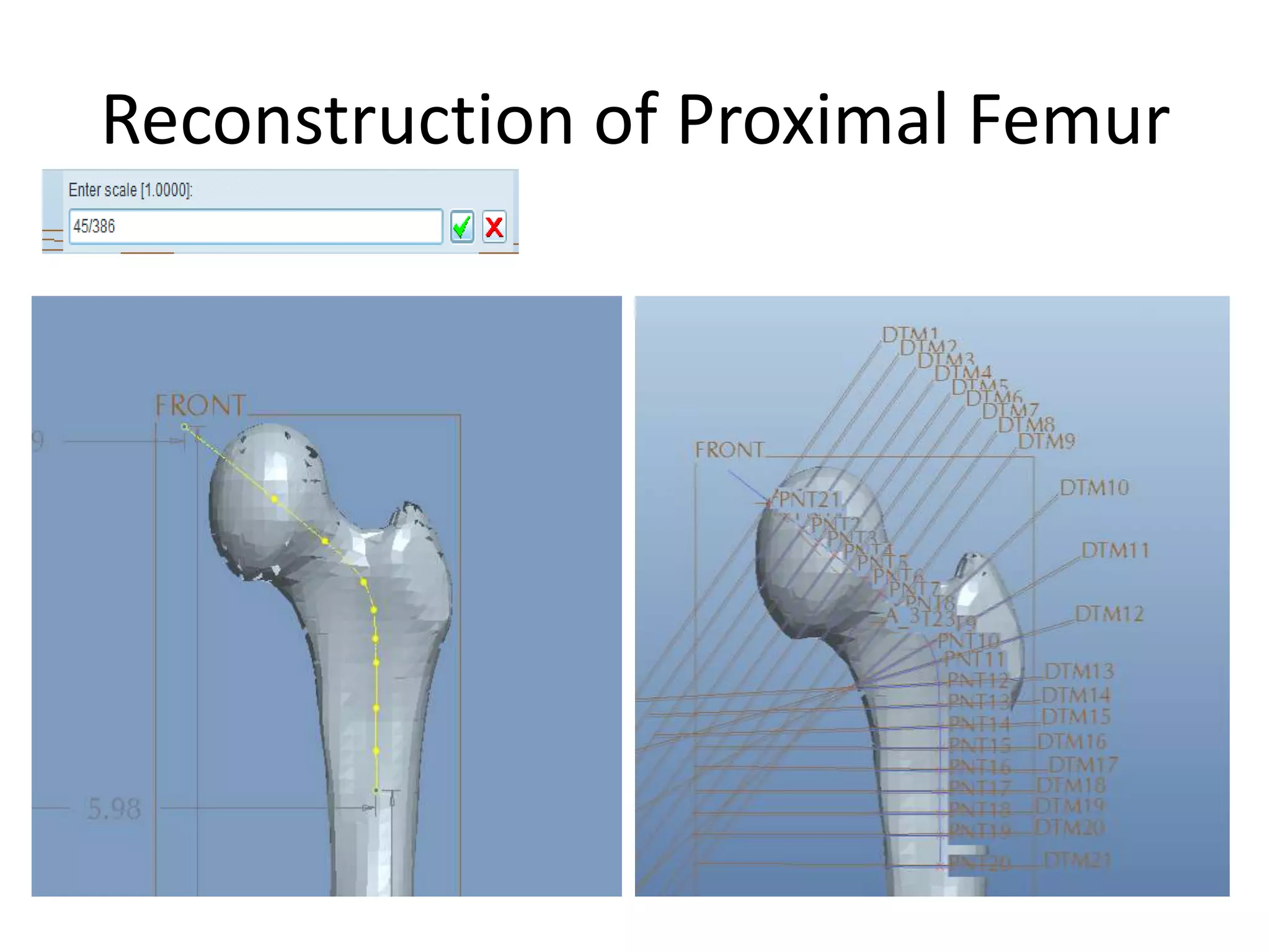 Reconstruction of Proximal FemurScale ModelSketch TrajectoryCreate Datum PlanesCreate SketchesUse Swept Blend
