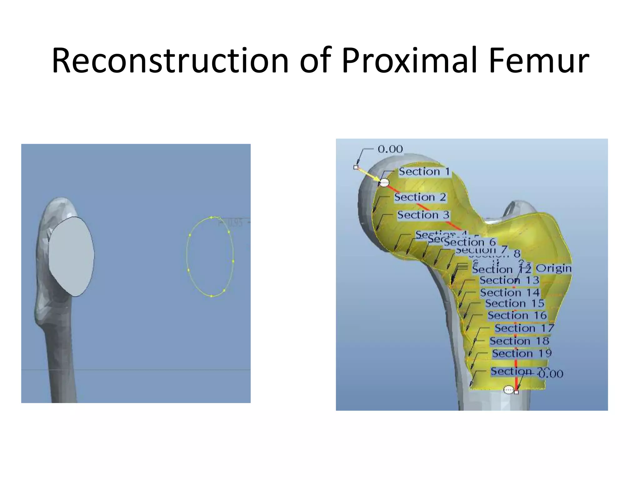 Reconstruction of Proximal Femur
