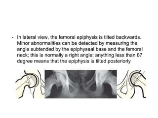 Slipped Capital Femoral Epiphysis (SCFE) | PPTX