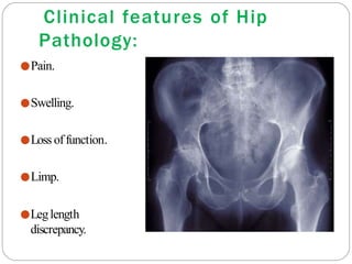 Clinical features of Hip
Pathology:
●Pain.
●Swelling.
●Loss offunction.
●Limp.
●Leglength
discrepancy.
 