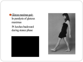 ●Gluteusmaximusgait-
In paralysisof gluteus
maximus
Pt lurchesbackward
during stance phase
 