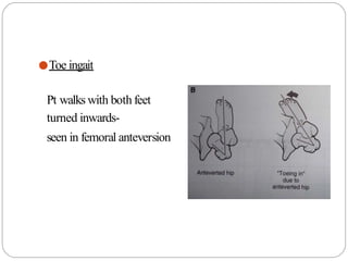 ●Toe ingait
Pt walks with both feet
turned inwards-
seen in femoral anteversion
 