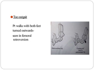 ●Toe outgait
Pt walks with both feet
turned outwards-
seen in femoral
retroversion
 