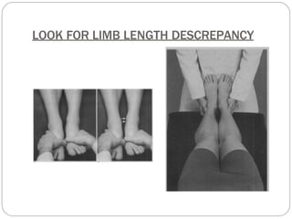 LOOK FOR LIMB LENGTH DESCREPANCY
 
