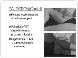 PALPATION(Contd)
●Femoral arterypulsation
at midinguinal pont
●Palpation ofGT:
smooth/irregular
proximal migration
●Digital Bryant’sTest
: supratrochanteric
shortening
 