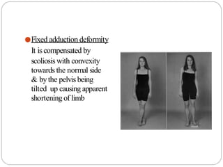 ●Fixed adduction deformity
It iscompensated by
scoliosis with convexity
towards the normal side
& bythe pelvisbeing
tilted up causing apparent
shortening of limb
 