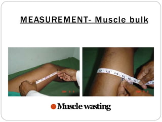 MEASUREMENT- Muscle bulk
●Musclewasting
 