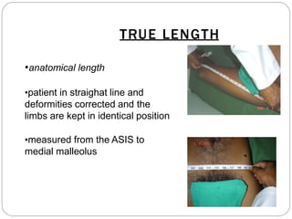 TRUE LENGTH
•anatomical length
•patient in straighat line and
deformities corrected and the
limbs are kept in identical position
•measured from the ASIS to
medial malleolus
 