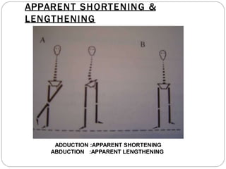 APPARENT SHORTENING &
LENGTHENING
ADDUCTION :APPARENT SHORTENING
ABDUCTION :APPARENT LENGTHENING
 