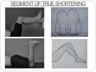 SEGMENTOFTRUESHORTENING
 