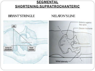 SEGMENTAL
SHORTENING:SUPRATROCHANTERIC
BR
Y
ANT’STRINGLE NELA
TON’SLINE
 