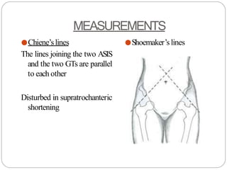 MEASUREMENTS
●Chiene’slines
The lines joining the two ASIS
and the two GTs are parallel
to each other
Disturbed in supratrochanteric
shortening
●Shoemaker’s lines
 