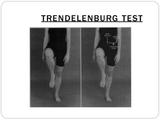 TRENDELENBURG TEST
 