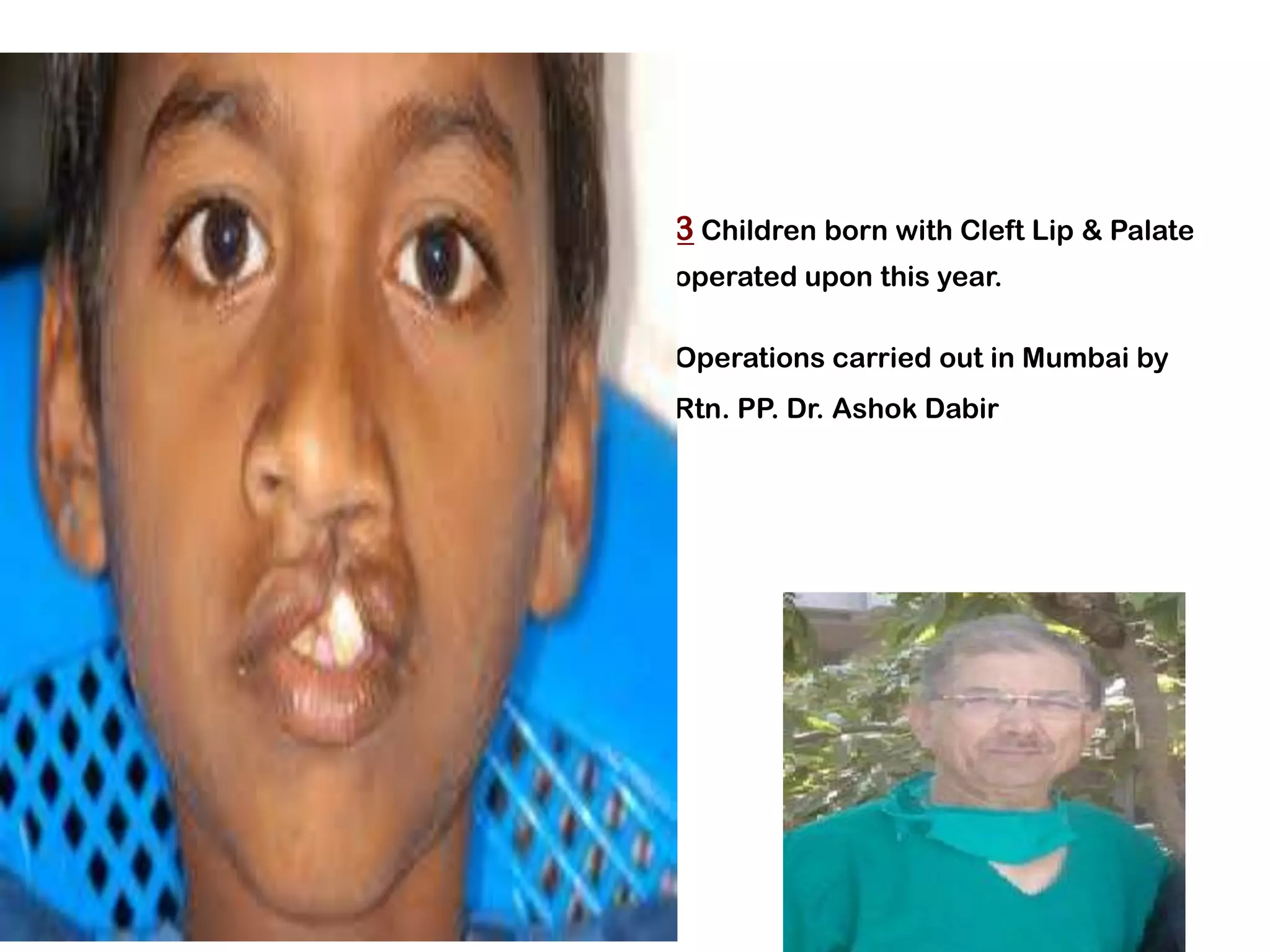•   3 Children born with Cleft Lip & Palate
    operated upon this year.

•   Operations carried out in Mumbai by
•   Rtn. PP. Dr. Ashok Dabir
 