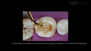 Traditional Layering vs. Modified Bulk Filling