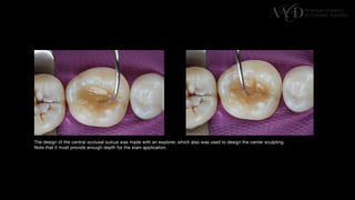 Traditional Layering vs. Modified Bulk Filling