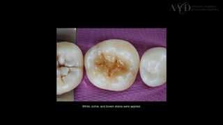 Traditional Layering vs. Modified Bulk Filling