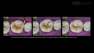 Traditional Layering vs. Modified Bulk Filling